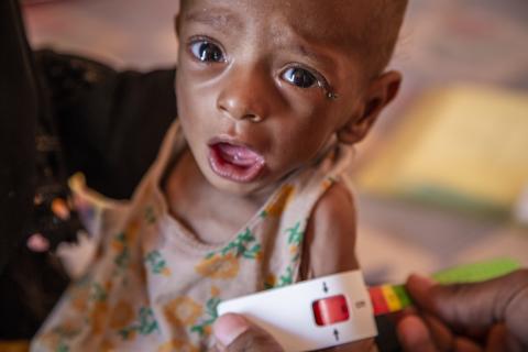  Bambino yemenita affetto da malnutrizione acuta grave - Save the Children