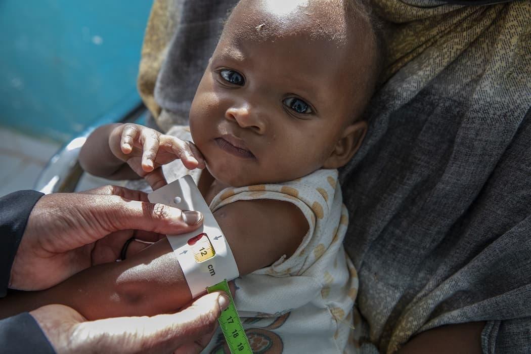 Operatore di Save the children misura la circonferenza del braccio di un bambino mal nutrito