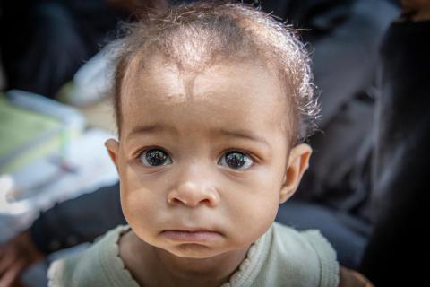 Bambino yemenita affetto da malnutrizione acuta grave - Save the Children